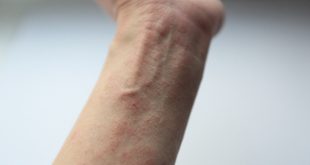 Pengertian Rubella, Penyebab, Gejala, Cara Penanganan dan Pencegahan Rubella Lengkap