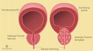 Pengertian Kelenjar Prostat, Fungsi Struktur dan Bagian Kelenjar Prostat Lengkap