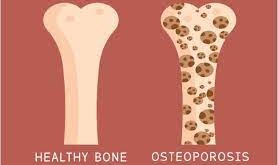 Kenali Penyebab Osteoporosis, Gejala, Hingga Pengobatannya