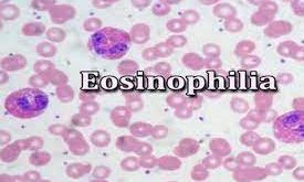 Mengenal Fungsi Eosinofil dan Cara Menurunkan Kadarnya